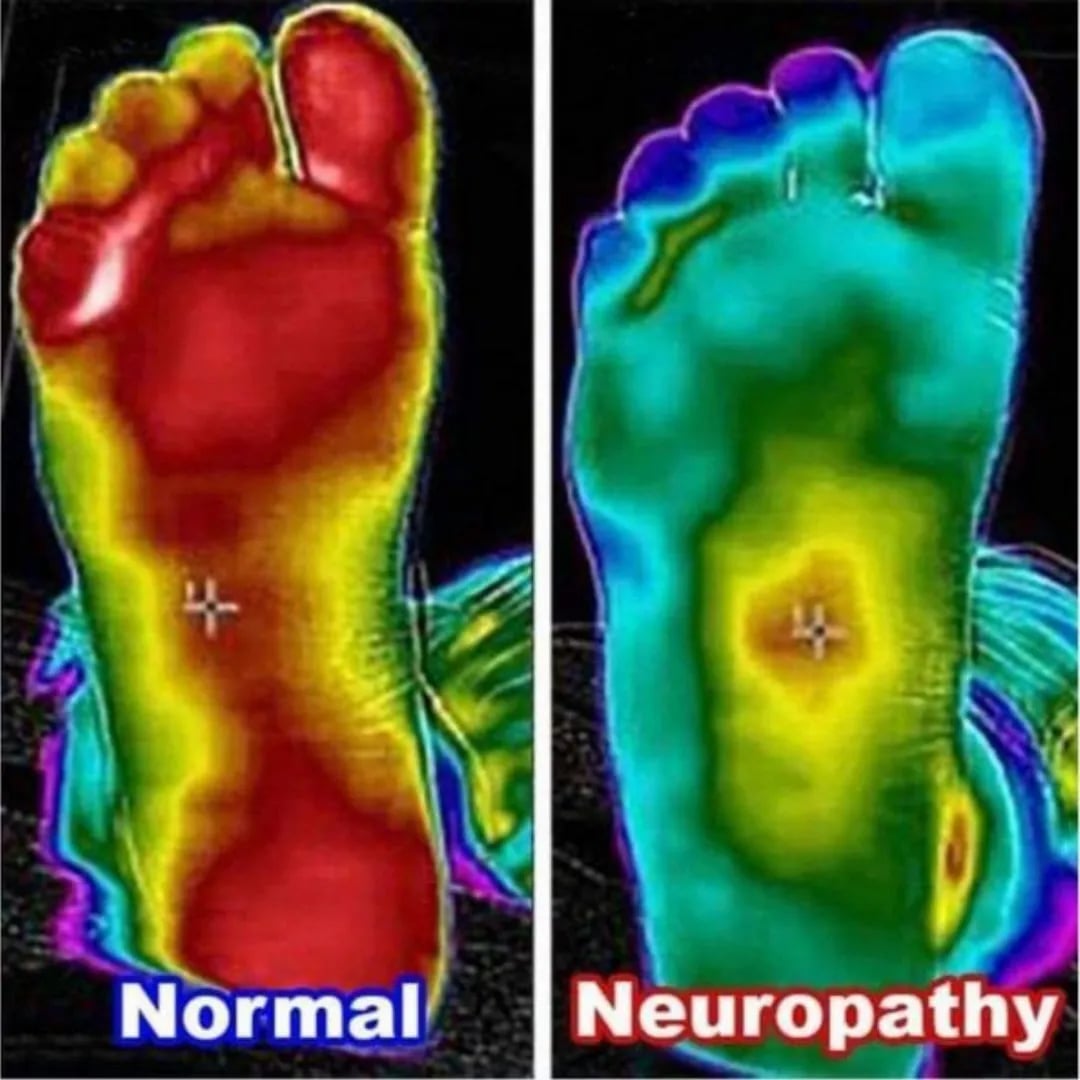 Neuropathy